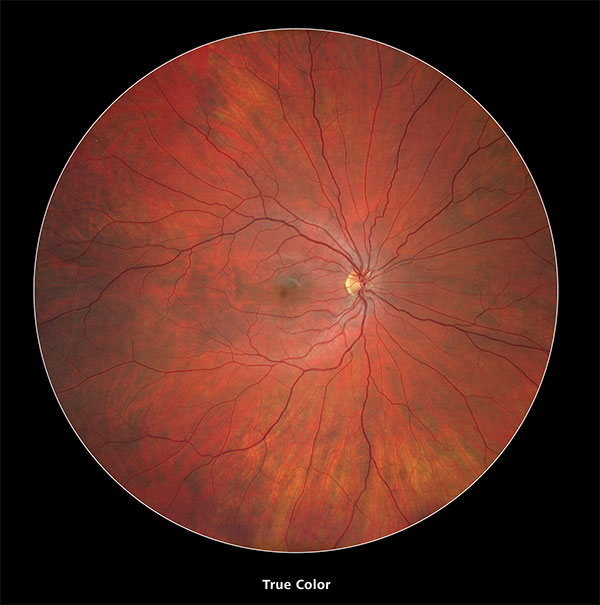 wide retinal photography image